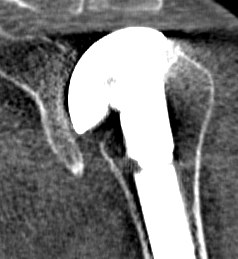 CT Shoulder Hemiarthroplasty for Osteoarthritis